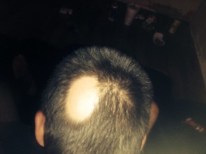 alopecia_areata