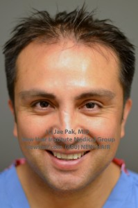 hair transplant new hair institute nhi 2