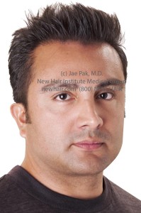 hair transplant new hair institute nhi 3