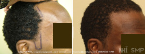 hair transplant side burn