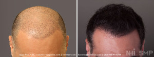 SMP Scalp Micropigment with FUE Hair Transplant for Fullness for Long Hair