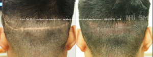 SMP - scalp micropigmentation to hair transplant scar