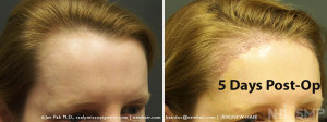 New Hair Institute Female Temple Corner Rounding 1000 grafts - 5 DAYS Post Op 