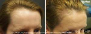 New Hair Institute Female Temple Corner Rounding 1000 grafts - 7 MONTHS Post Op