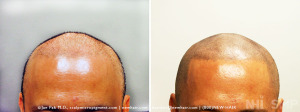 nhi_smp_bold hair line