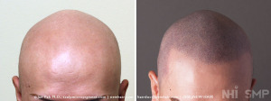 Scalp MicroPigmentation for Alopecia Totalis