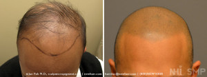 NHI Scalp MicroPigmentation Before After