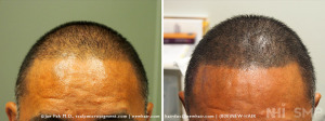 SMP to thinning hair