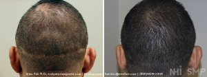 SMP to Hair Transplant Scar