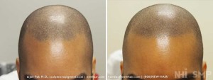 New Hair Institute Scalp MicroPigmentation