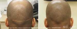 New Hair Institute Scalp MicroPigmentation