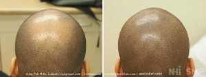 New Hair Institute Scalp MicroPigmentation