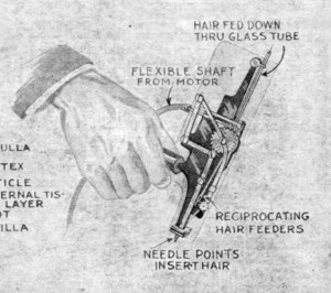 hair transplant