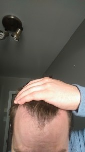 FUE 1200 grafts recommended by one doctor