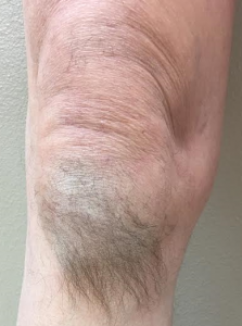 hairykneww1