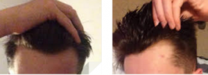 10 with early balding