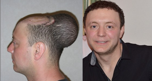 before and after balloon