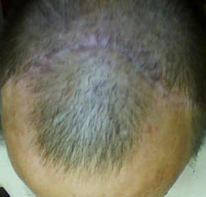 forehead lift scar