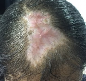 scalp necrosis