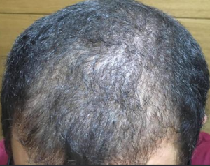 thinning hair