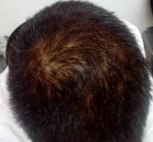 21 with thinning crown