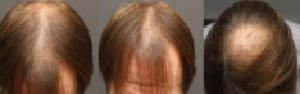 before laser hat