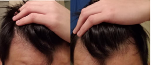 how many grafts 27 year old