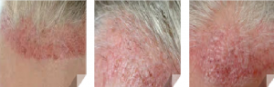 persistent redness 8 wks
