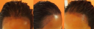 saudi female hairline