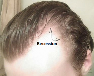 can finasteride help temple and corner recession