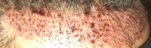 1500 grafts in 40 minutes