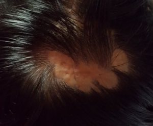crown burn