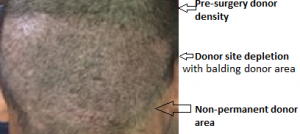 depleted donor area 6