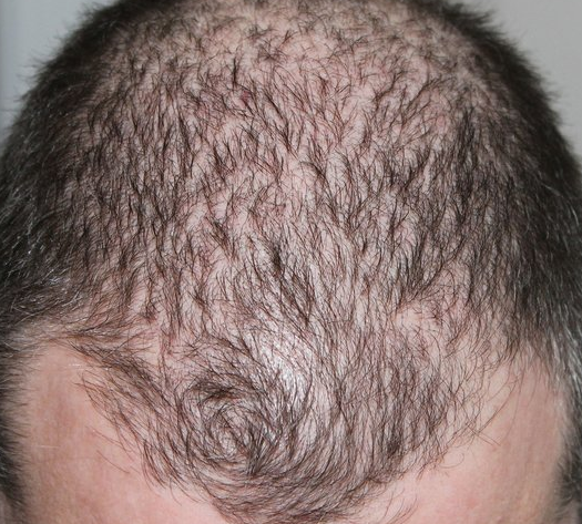 thinning 21 yeaar old male