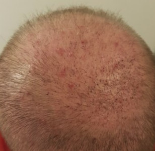 lotsof pimples