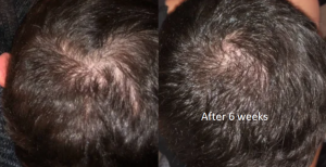 6 weeks on finasteride