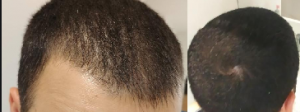 question balding