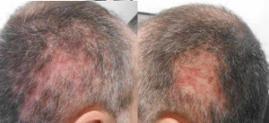 scarring from necrosis