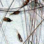 Lice