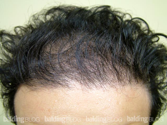 Hairline