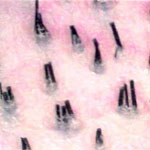 Hair graft