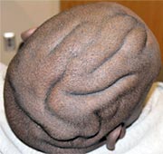 Cutis Verticis Gyrata