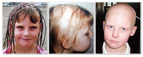 Traction alopecia