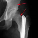 Fibrous dysplasia