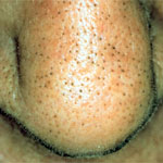Trichostasis spinulosa