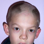 Trichotillomania
