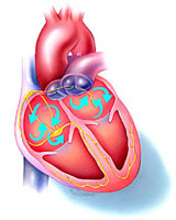 Atrial fibrillation