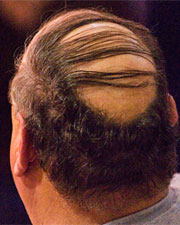 Combover