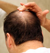 Minoxidil